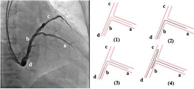 A Novel Approach for Repetitive Dislocation of Transvenous Left Ventricular Leads During Cardiac Resynchronization Therapy Implantation by the Loop Technique